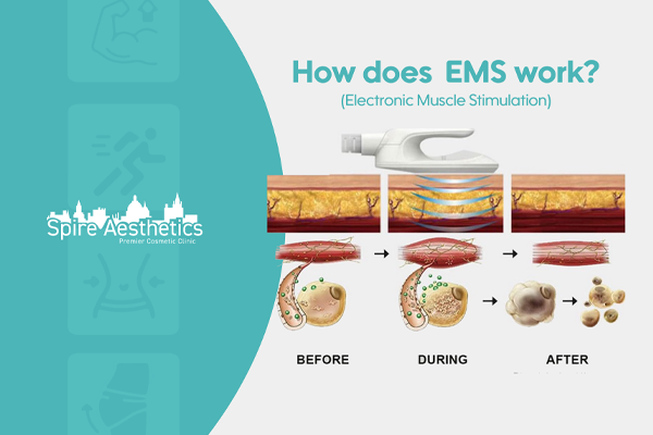 EMS treatment for post pregnancy weight loss treatment Kent