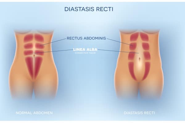 What Non-Surgical Options Are Available for Diastasis Recti Kent?