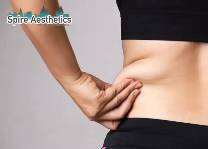 Image of woman pinching fat on their hips Kent. Fat Freezing treatment 
