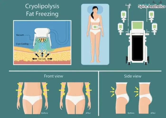 Fat freezing treatment Kent benefits for competitions to remove stubborn fat deposits.