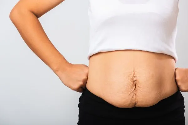 Image of a woman's stomach after weight loss with sagging skin following a gastric band Kent