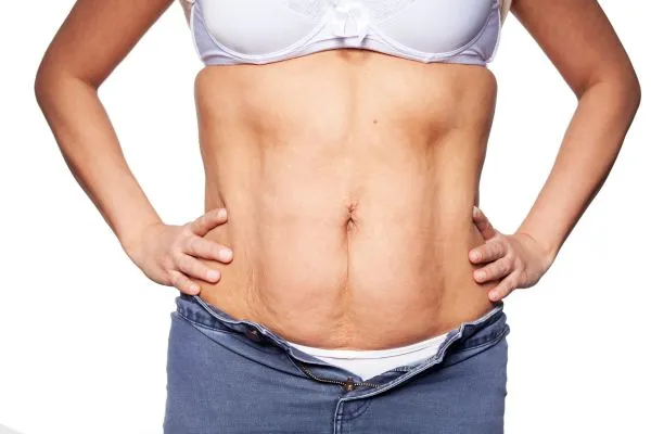 sagging skin on woman's stomach after weight loss injections Kent