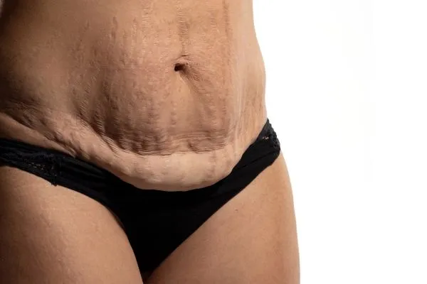 Image of womans stomach after weight loss injections Kent showing saggy skin