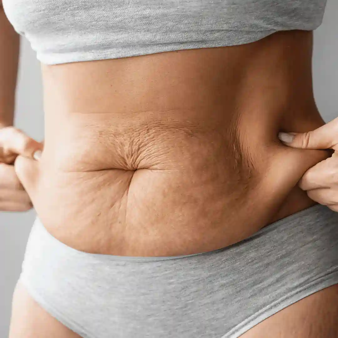 Is It Normal to Have Loose Skin After Pregnancy Kent?