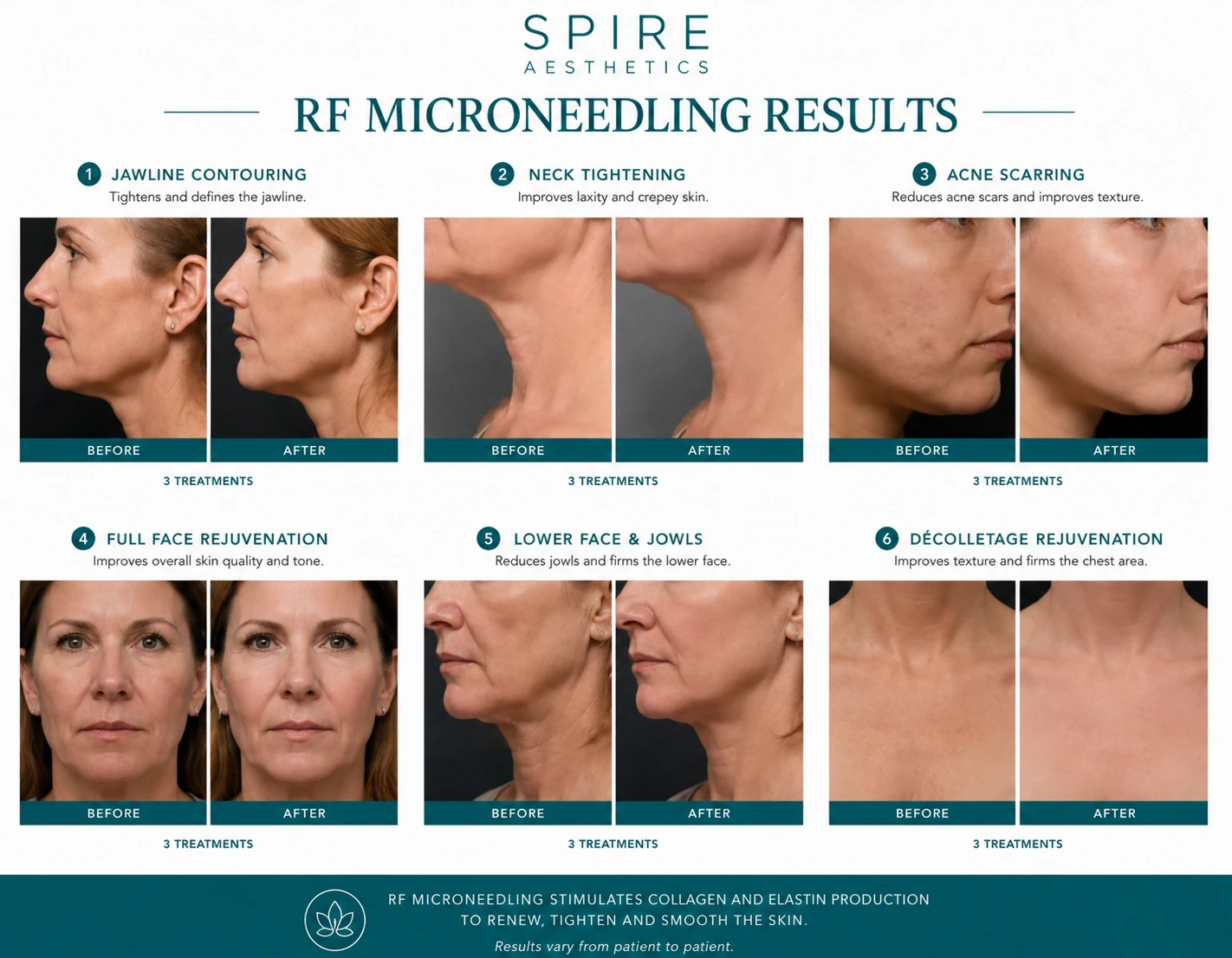 RF Microneedling Skin tightening Kent results