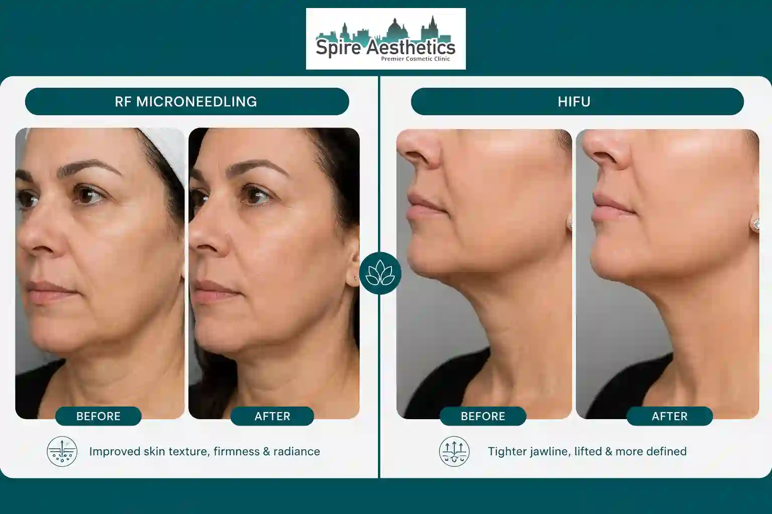 Can RF Microneedling and HIFU Be Combined Kent?