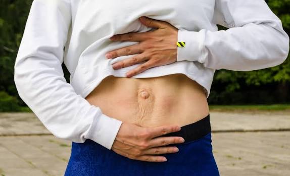When Could Diastasis Recti Be the Missing Piece of the Puzzle Kent?