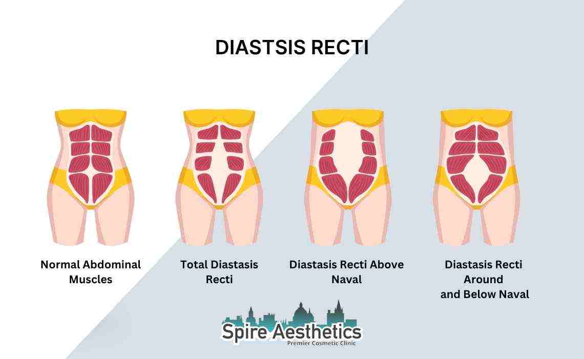 Is Non-Surgical Diastasis Recti Treatment Right for You? Common Concerns Answered Kent